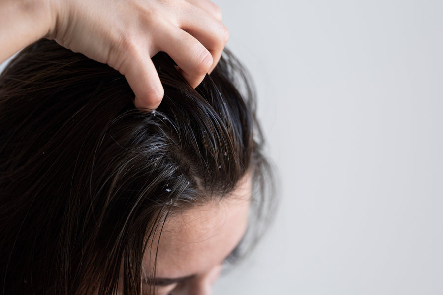 Scalp Care for Seborrheic Dermatitis: Why Your Scalp Needs a Skincare Routine
