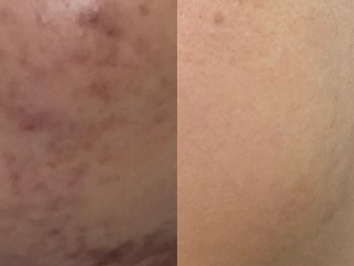 From Inflammation to Calm: My Journey with ERIGERON’s Cleanser and Serum