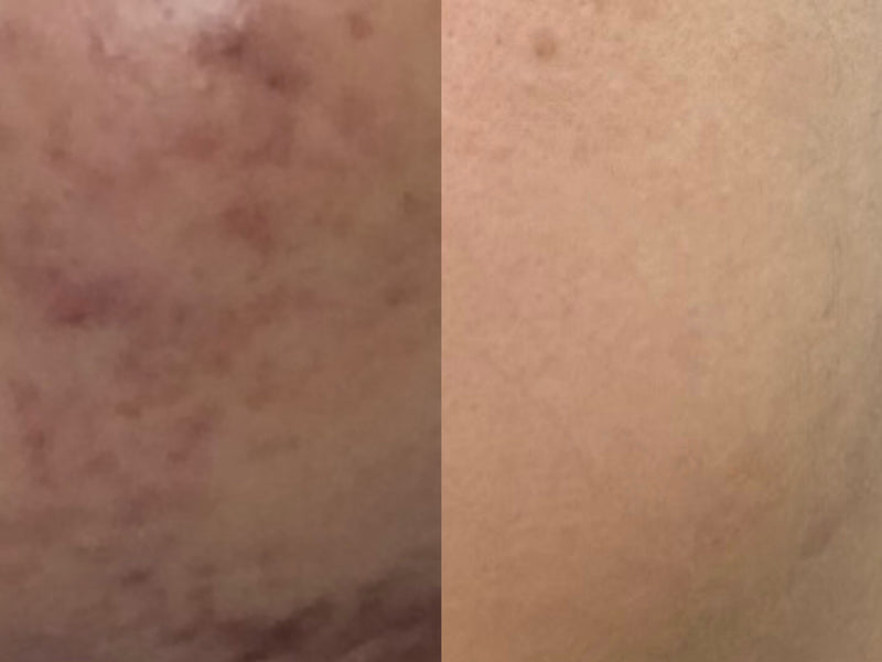 From Inflammation to Calm: My Journey with ERIGERON’s Cleanser and Serum